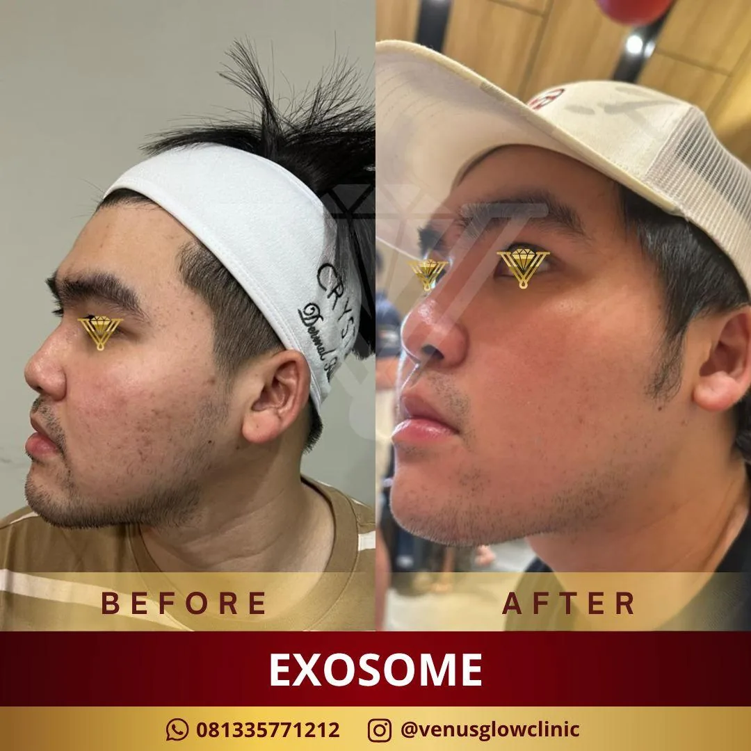 Before & after — Exosome