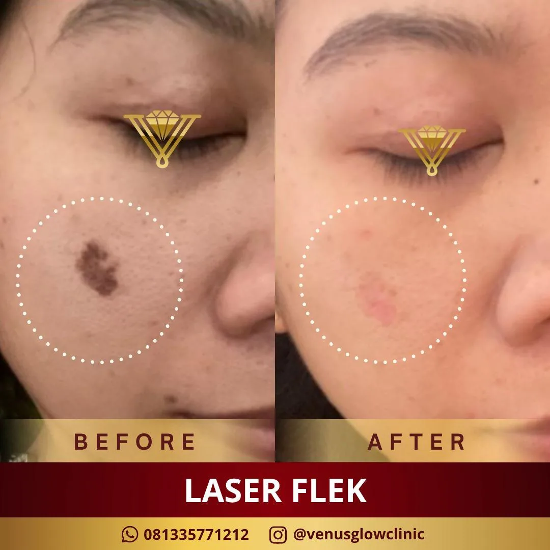 Before & after — Laser Flek