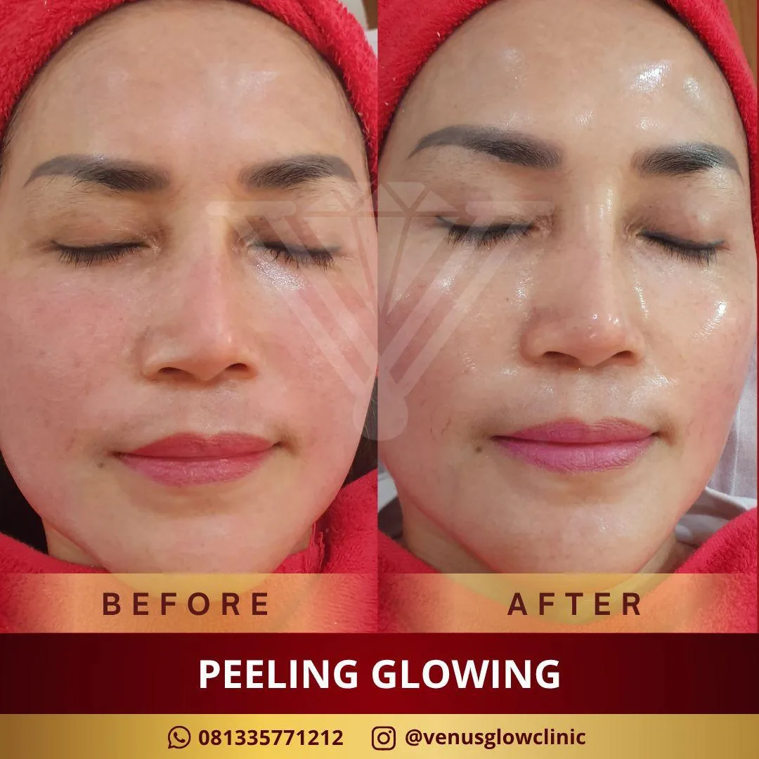 Before & after — Peeling Glowing