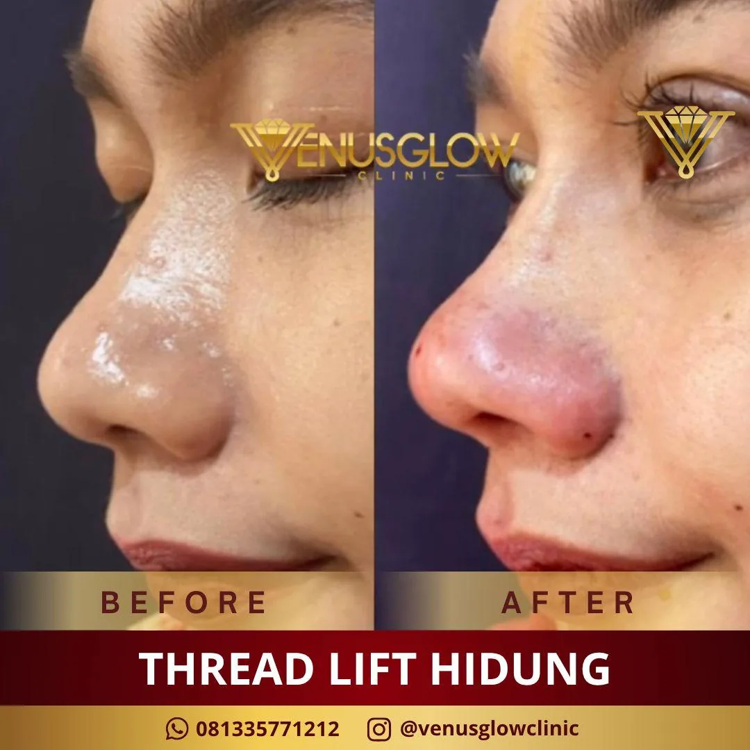 Before & after — Threadlift Hidung